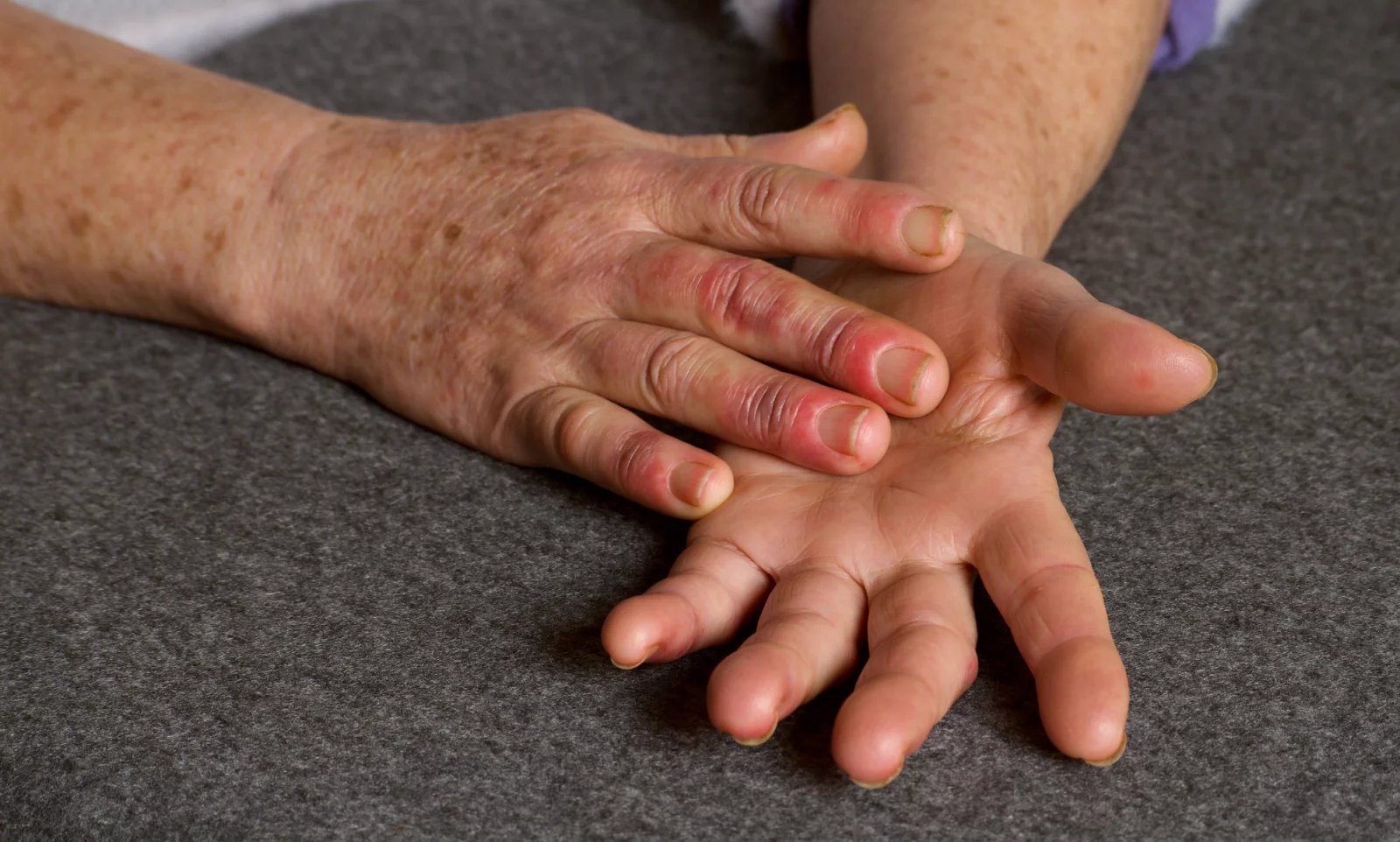 Každá z autoimunitních nemocí má jiné charakteristické symptomy. Zatímco u již zmíněné Crohnovy choroby jsou to střevní potíže a bolesti břicha, pro cukrovku 1. typu je typická enormní žízeň.