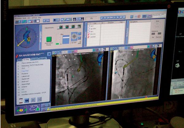 Obr. 6 – Detailní obraz navigační obrazovky, která umožňuje měnit vektor magnetického pole a tím i výchylku a změnu polohy mapovacího katétru