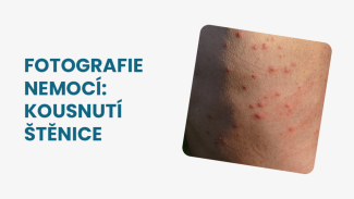 Náhledový obrázek - Kousnutí od štěnice foto: jak ho poznat a čím se liší oproti kousnutí jiným hmyzem?