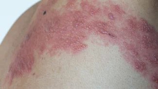 Náhledový obrázek - Prvním příznakem pásového oparu bývá přecitlivělost a brnění. Přibližně po dvou dnech se objeví vyrážka