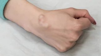 Náhledový obrázek - Neurofibromatóza se může projevit už po narození. Typickými příznaky jsou skvrny a nádory na kůži