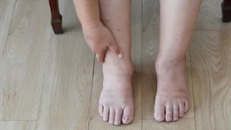 Náhledový obrázek - Zadržování vody v těle způsobuje nejen otoky končetin. Pozor si dejte na příjem soli i pitný režim