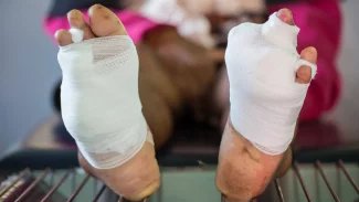Náhledový obrázek - Sněť si lidé často pletou se snětí slezinnou. Nejčetněji jí bývají postiženy horní a dolní končetiny