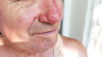Rosacea (růžovka)