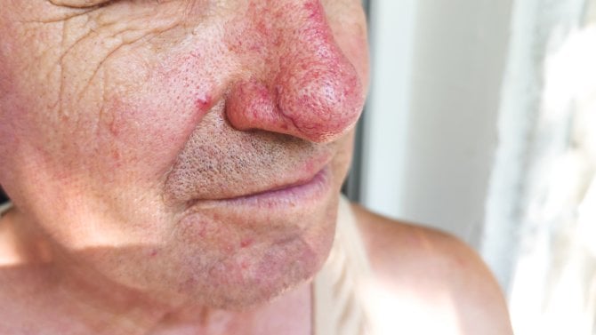 Rosacea (růžovka)