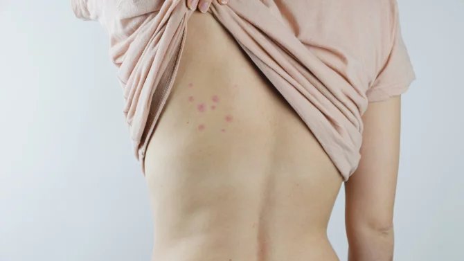 Pokud si přinesete například z dovolené několik jedinců, je možné použít běžné komerčně dostupné biocidní přípravky… Pokud je výskyt většího rozsahu, je potřeba zajistit likvidaci štěnic osobou, která má odbornou způsobilost k provádění speciální ochranné dezinsekce, uvádí na svém webu ostravská hygienická stanice.