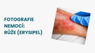 Náhledový obrázek - Růže je infekční kožní onemocnění způsobené streptokokem. Víte, jak jí rozpoznat?