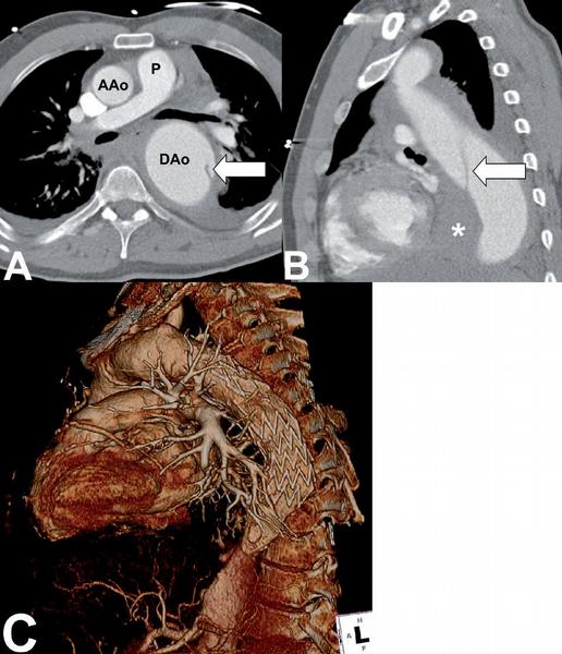 Obr. 22 – Disekce aorty. A) Aneuryzmatické rozšíření descendentní hrudní aorty (DAo) s odtrženou intimou (šipka). Ascendentní aorta (AAo) je obvyklé šíře, bez známek disekce. Pulmonální trunkus (P) a jeho větve komprimovány. B) V sagitální projekci zobrazen rozsáhlý hematom mezi aortou a srdcem. C) Kontrolní CT angiografie po implantaci stentgraftu je s příznivým nálezem, vak aneuryz- matu je vyřazen z cirkulace, bez známek krvácení do stěny aorty či mimo ni.