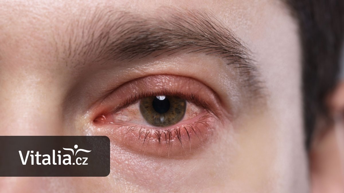 Zánět spojivek může skončit poškozením zraku. V létě hrozí víc než jindy
