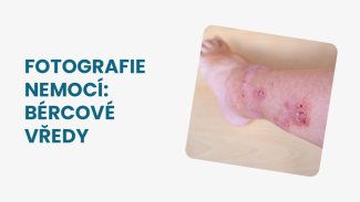 Náhledový obrázek - Bércové vředy foto: znaky, podle kterých rozpoznáte, zda se vás tato kožní nemoc týká