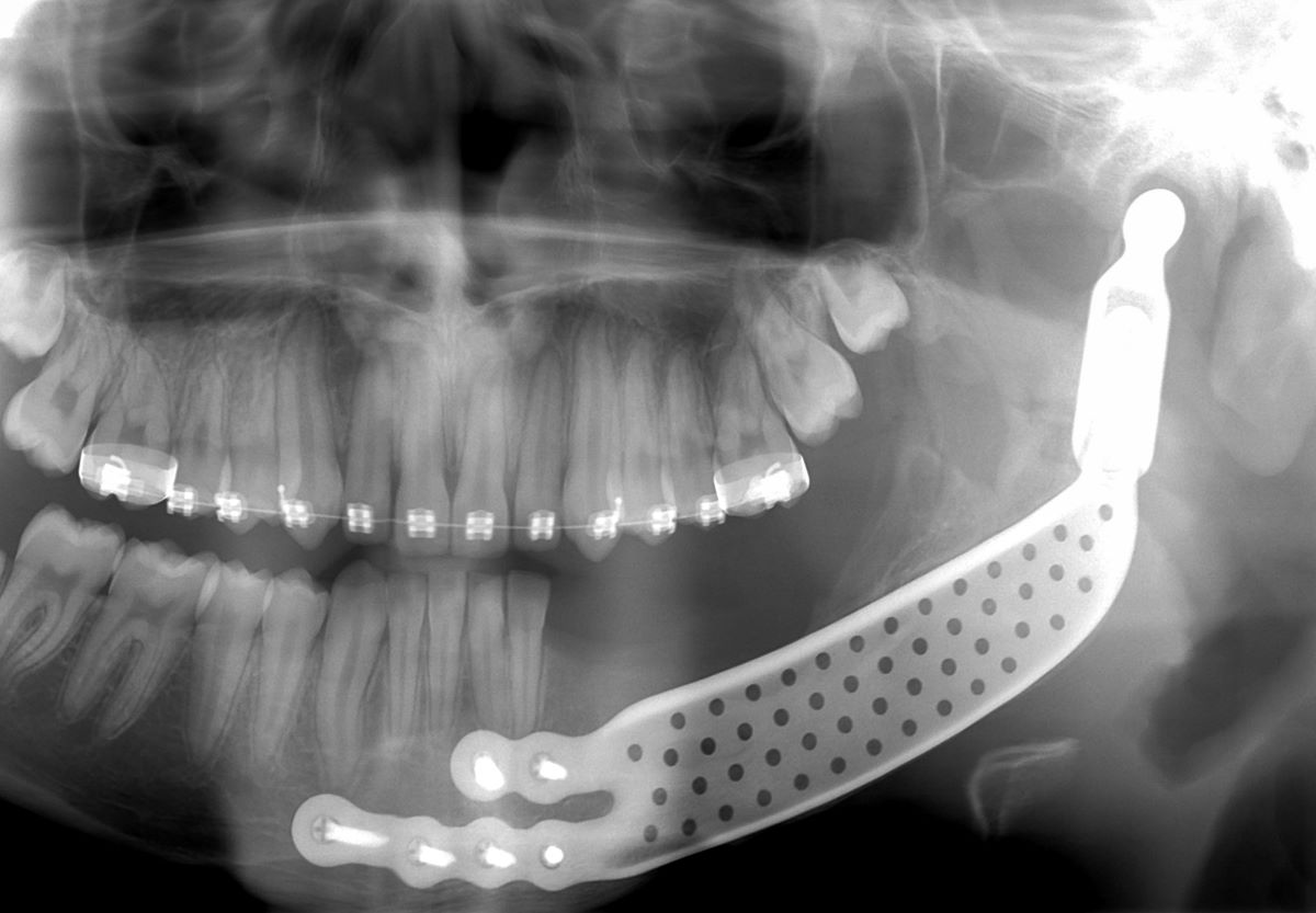 Kvůli nádoru přišel chlapec o polovinu dolní čelisti. Lékaři mu pomohli titanovou náhradou i díky 3D tisku