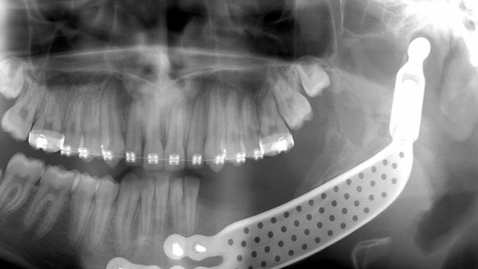 Kvůli nádoru přišel chlapec o polovinu dolní čelisti. Lékaři mu pomohli titanovou náhradou i díky 3D tisku