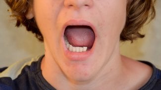 Kvůli nádoru přišel chlapec o polovinu dolní čelisti. Lékaři mu pomohli titanovou náhradou i díky 3D tisku
