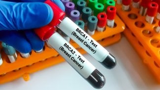 Test na mutaci genů BRCA