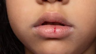 Náhledový obrázek - Popraskané rty jsou běžným problémem. Léčit je lze úpravou životosprávy či výměnou kosmetických produktů