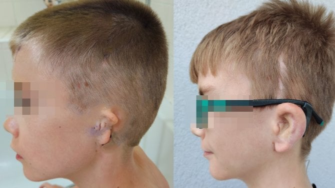 Boltec před operací a po ní