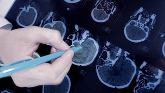 Britští výzkumníci vyvinuli nový test pro diagnostiku mozkových nádorů. Čekání na výsledek zkrátí z týdnů na pouhé hodiny