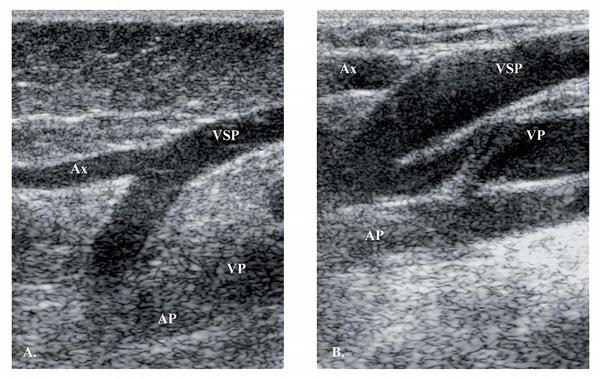 Obr. 1 – Srovnání funkční a nefunkční (insuficientní) malé safény v podkolenní jamce, kde ústí do podkolenní žíly (SPJ): A – nedilatovaná malá saféna bez refluxu, B – dilatovaná malá saféna, insuficienci žíly je potřebné prokázat pulsním dopplerometrickým vyšetřením (PW Doppler, viz Obr. 2) (B-mód, podélné zobrazení, lineární sonda 6,7 MHz). VP – v. poplitea, AP – a. poplitea, VSP – v. saphena parva, SPJ – safenopopliteální junkce (místo vyústění malé safény do podkolenní žíly), Ax – axiální prodloužení malé safény na zadní stranu stehna (anatomická variace).