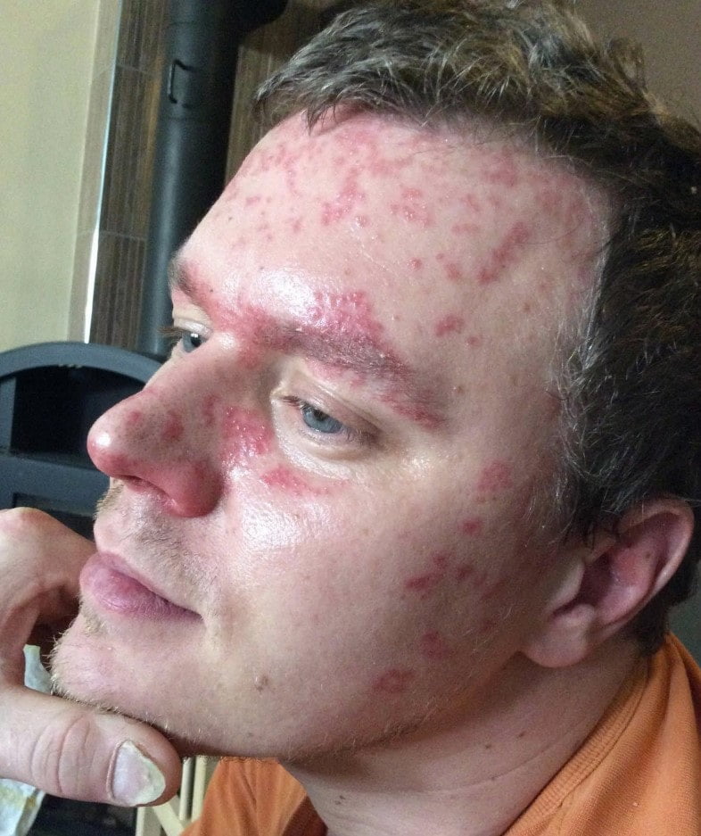 Tomáš zprvu trpěl lupénkou, z ní se pak vyvinula artritida