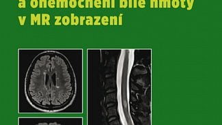 Náhledový obrázek - Roztroušená skleróza a onemocnění bílé hmoty v MR zobrazení