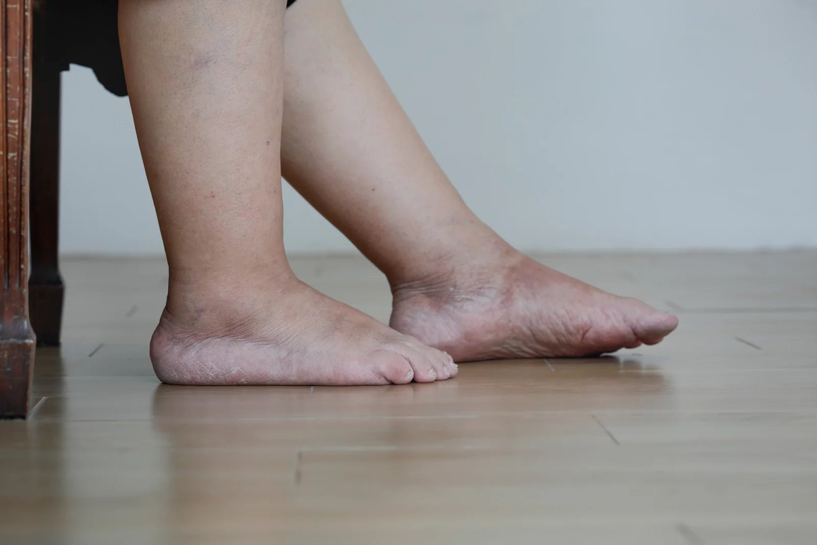 Nadváha a obezita zvyšují tlak na nohy a mohou tak způsobit otoky. Silní lidé také často zadržují v těle vodu, otoky pak vznikají, když se voda nahromadí.