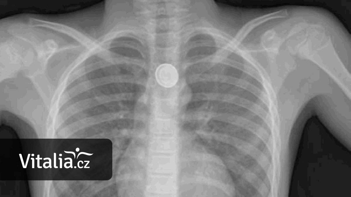 Spolknutá baterie dokáže dítěti proděravět jícen za pouhé čtyři hodiny. První pomocí je med