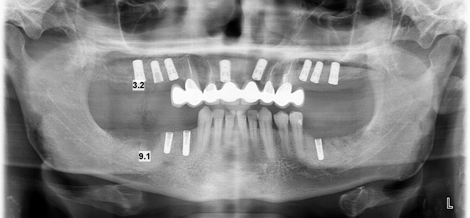 Zubní implantáty