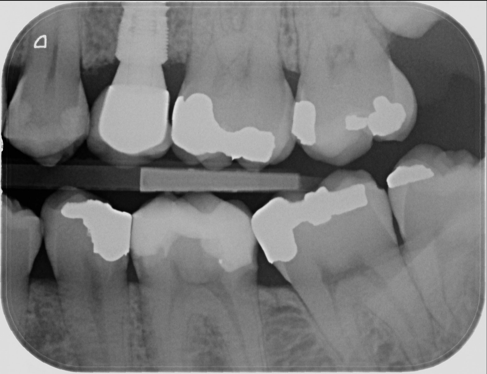 Zubní implantáty