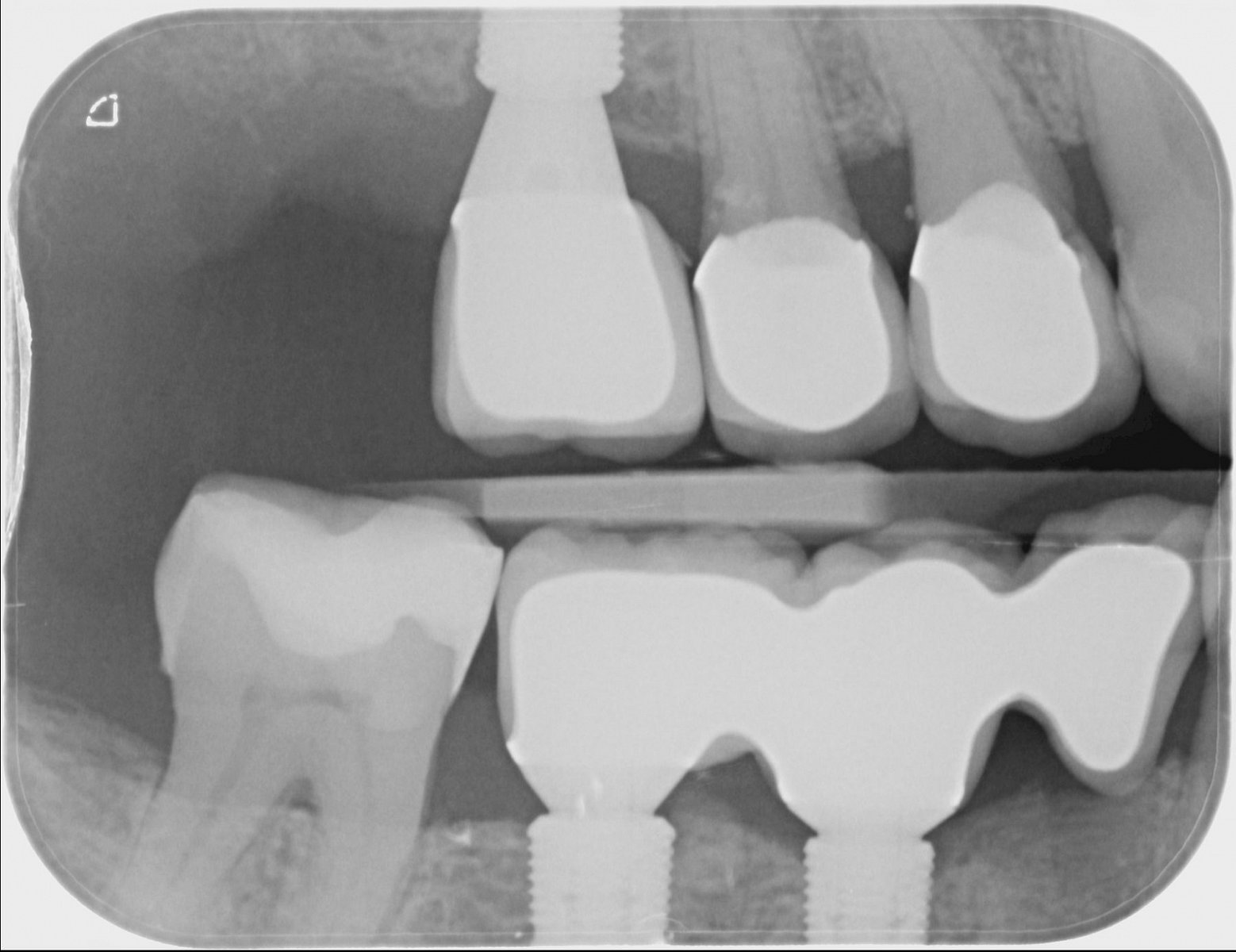 Zubní implantáty