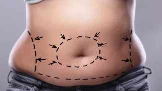 Náhledový obrázek - Abdominoplastika dokáže pacienta zbavit tuku a přebytečné kůže. Dá se s ní řešit i diastáza