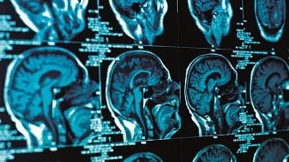 Náhledový obrázek - Pacientům s Parkinsonem chybějí služby i specializovaná zařízení