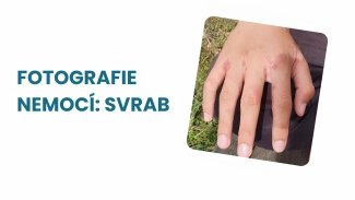 Náhledový obrázek - Svrab obrázky a fotografie – Jak poznat tuto nepříjemnou nemoc?