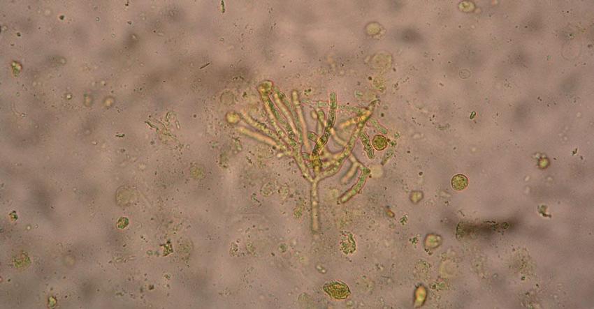 Obr. 1 – Mykotická vlákna (Aspergillus) v nativním preparátu z BAT