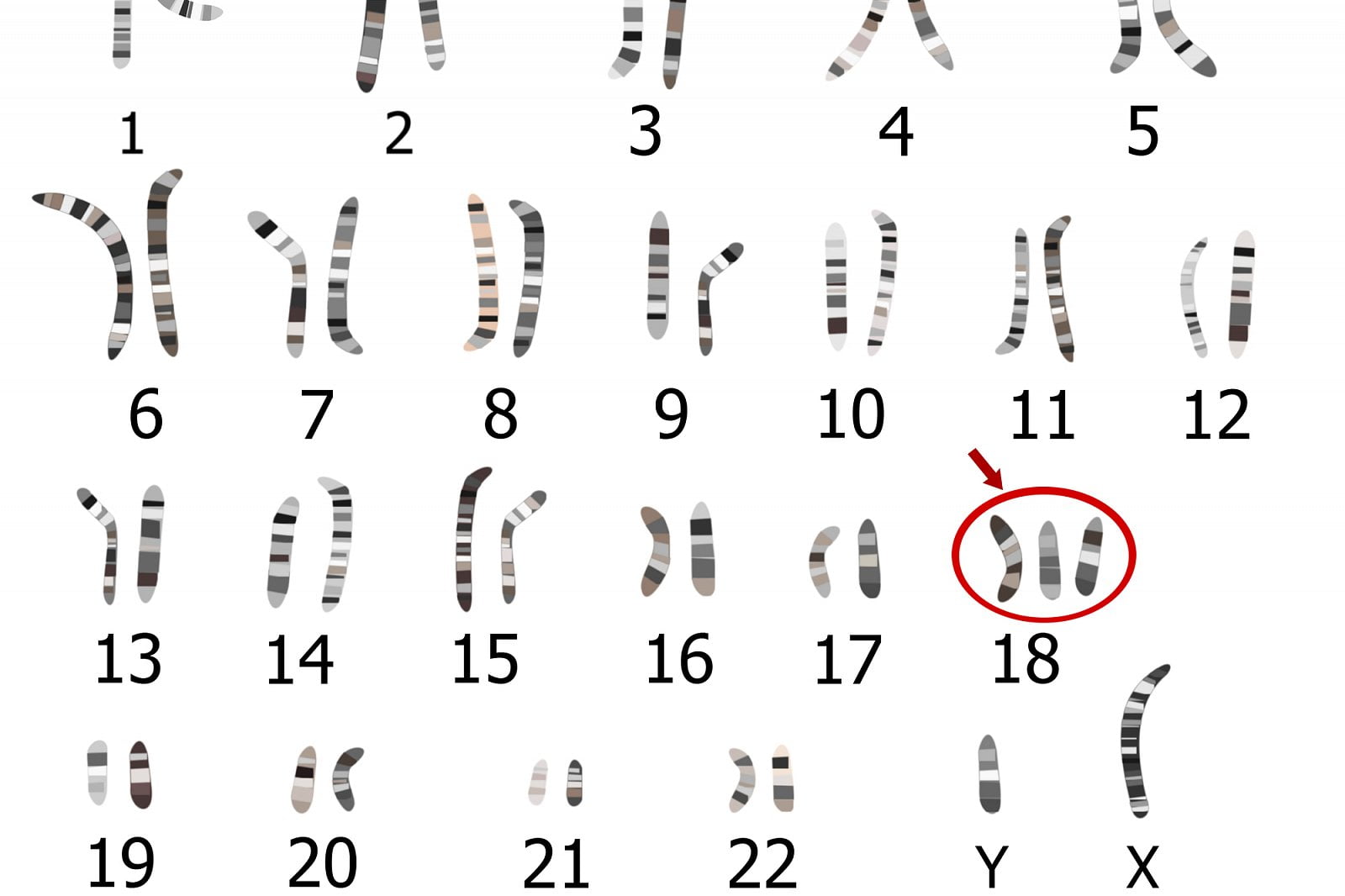 Genetická onemocnění vzniklá chybami v počtu či tvaru chromozomů