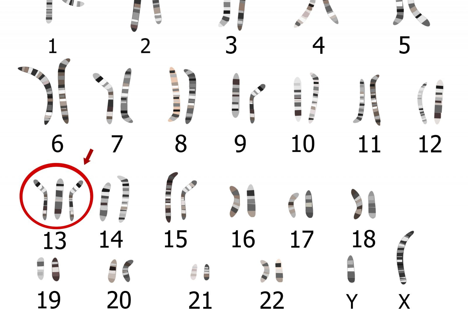 Genetická onemocnění vzniklá chybami v počtu či tvaru chromozomů