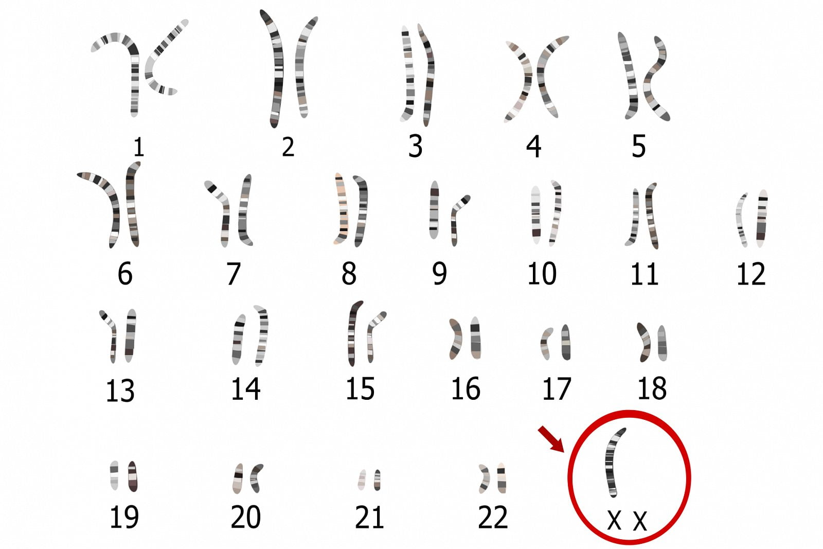 Genetická onemocnění vzniklá chybami v počtu či tvaru chromozomů