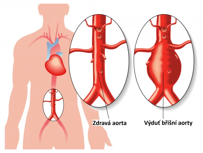 Nákres zdravé břišní aorty a aorty s výdutí