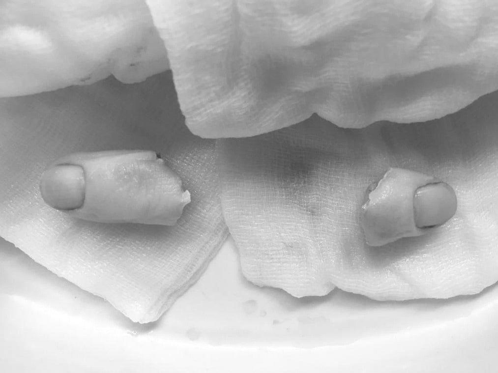 Co dělat, když si uříznete prst? Důležité je zabalit správně amputát.