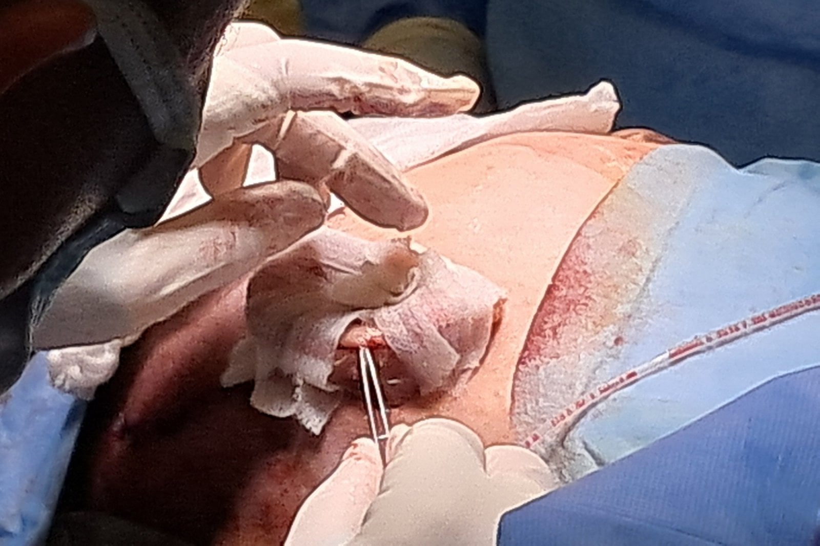 Nová metoda léčby dětí s mikrocií