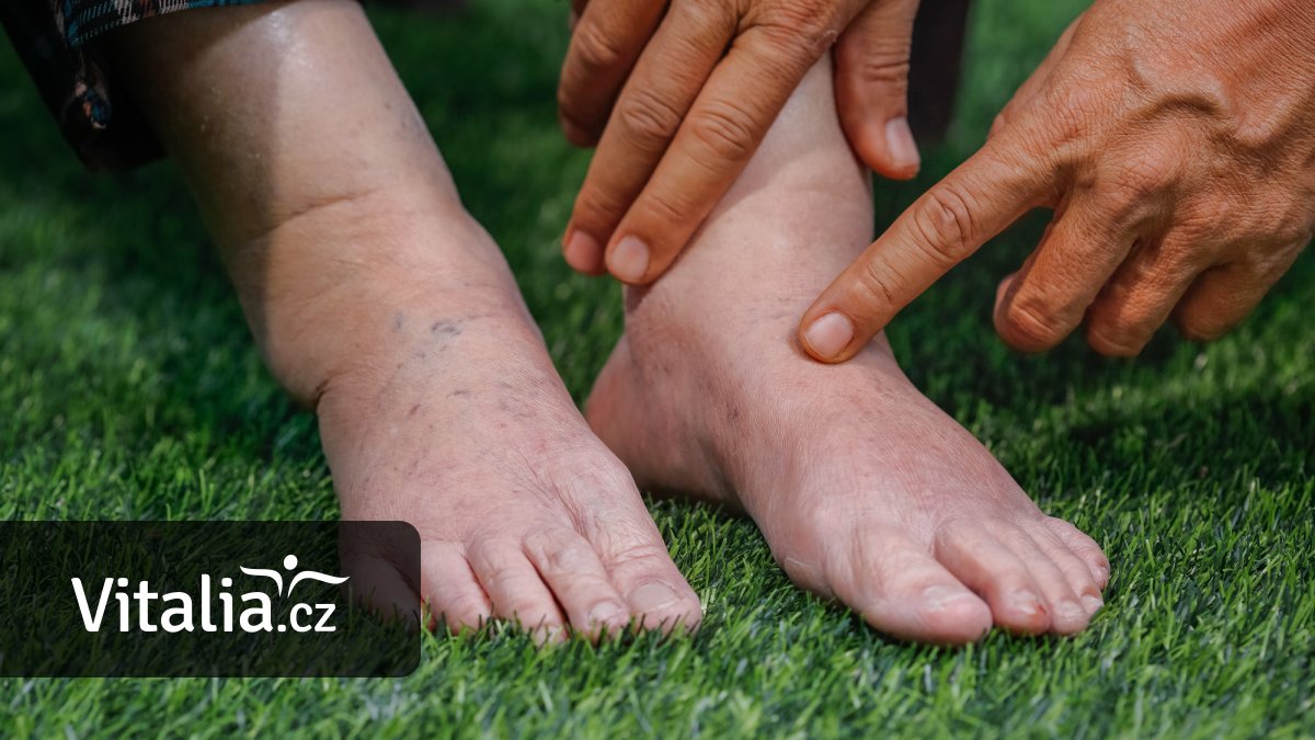 Potíže s lymfou se projeví hlavně otoky. Pomůže hluboké dýchání i pohyb