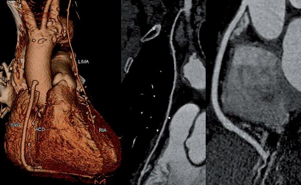 Obr. 7 – CT vyšetření po chirurgické revaskularizaci. Aortokoronární žilní bypass (SVG) na distální úsek pravé koronární tepny (ACD), která je ve středním úseku segmentárně uzavřena. Mamokoronární bypass z levé mamární tepny (LIMA) na distální úsek ramus interventricularis anterior (RIA).