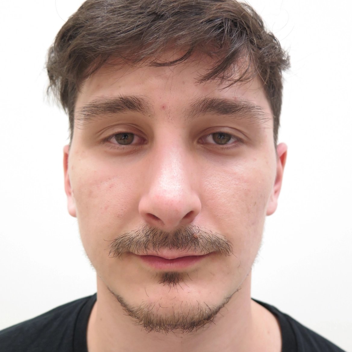 Plastická operace nosu: před a po, pacient