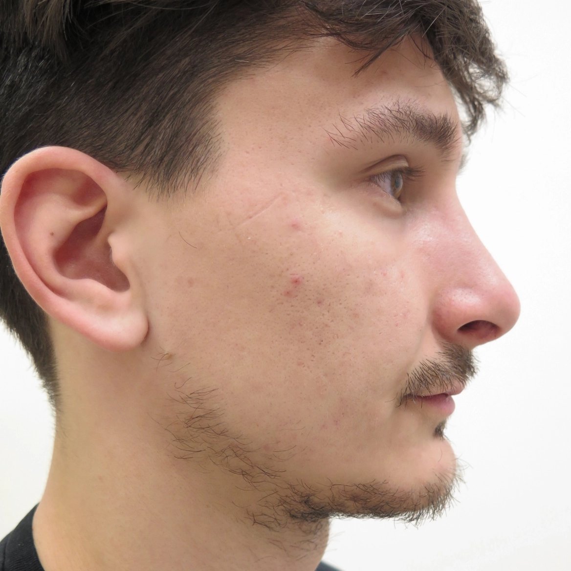 Plastická operace nosu: před a po, pacient