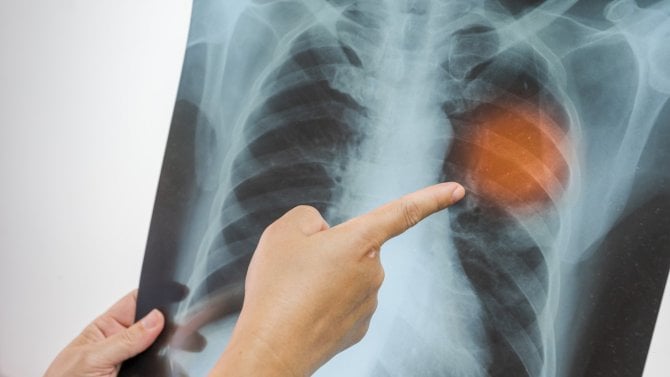 Opravy kostí na počkání. Vědci vyvinuli „tavnou pistoli“, která je dokáže slepit přímo na sále