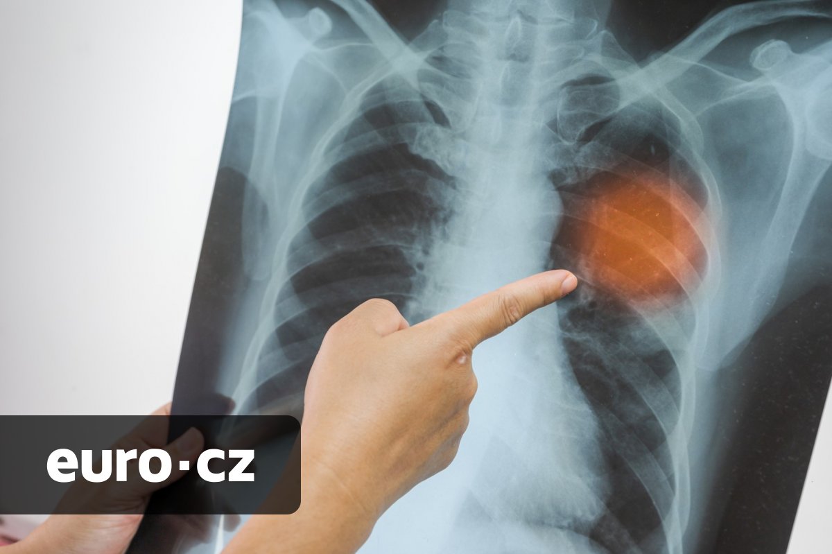 Opravy kostí na počkání. Vědci vyvinuli „tavnou pistoli“, která je dokáže slepit přímo na sále