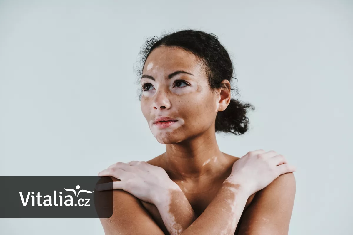 Vitiligo: příčiny a jak se ho zbavit - Vitalia.cz