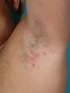 Hidradenitis suppurativa, II. Hurleyho stadium