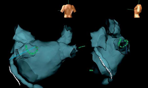 Obr. 2 – Elektroanatomická 3D mapa (zobrazení NavX – SJM Inc.) v předozadní projekci a levé laterální projekci se zobrazenými katétry:1. v koronárním sinu, 2. v ústí levé dolní plicní žíly a 3. ablační katétr hluboko v pravé dolní plicní žíle.