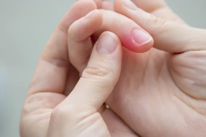 Absces se může objevit i u nehtu. Jde o komplikaci zánětu nehtového lůžka coby důsledek modeláže nehtů, nešetrné manikúry nebo kousání nehtů.