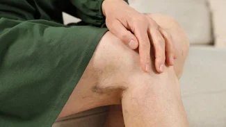 Náhledový obrázek - Příznaky trombózy se projevují zejména v dolních končetinách. Typická je bolest a otok